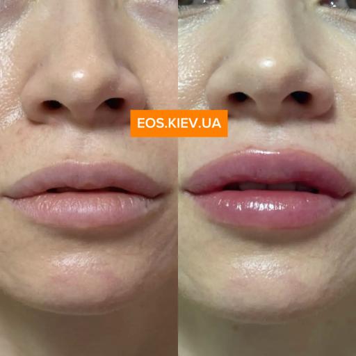 Интенсивный плампер для губ с микроиглами VT COSMETICS Reedle Shot Lip Plumper Expert 4,3 г