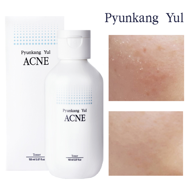 Тонер для проблемной кожи PYUNKANG YUL Acne Toner 150 мл (Цена: 455 грн.)