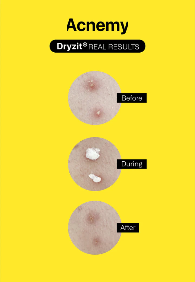 Подсушивающий лосьон от воспалений ACNEMY Dryzit 30 мл (Цена: 1 437 грн.)